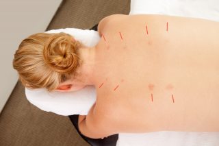 Acupuncture